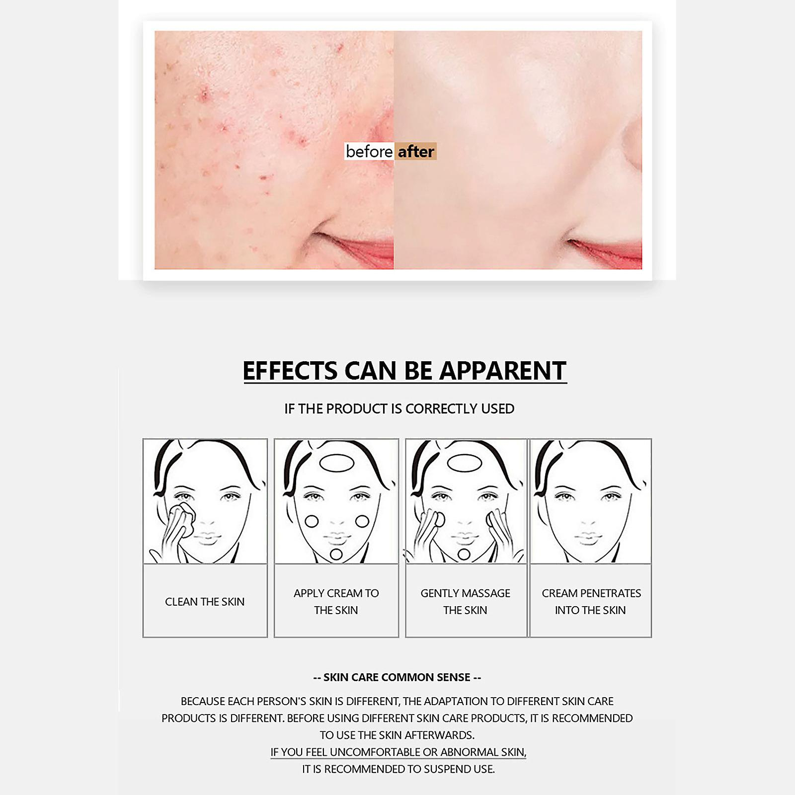 Foto 6 pulgar | Crema De Eliminación De Cicatrices De Acné Huoguo Para Aceite Facial Y Agua Bala - Venta Internacional.