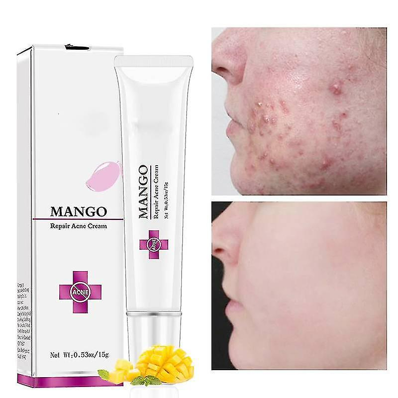 Foto 2 pulgar | Kit De Tratamiento Para El Acné Huoguo Crema Antiacné Para Cicatrices  15 G - Venta Internacional.