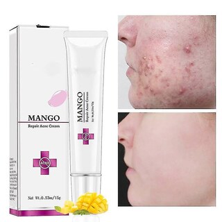 Foto 1 | Kit De Tratamiento Para El Acné Huoguo Crema Antiacné Para Cicatrices 15 G - Venta Internacional.