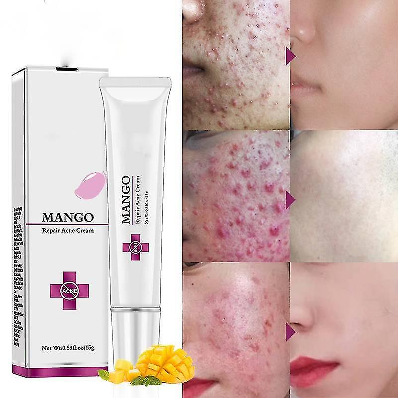 Foto 3 pulgar | Kit De Tratamiento Para El Acné Huoguo Crema Antiacné Para Cicatrices  15 G - Venta Internacional.