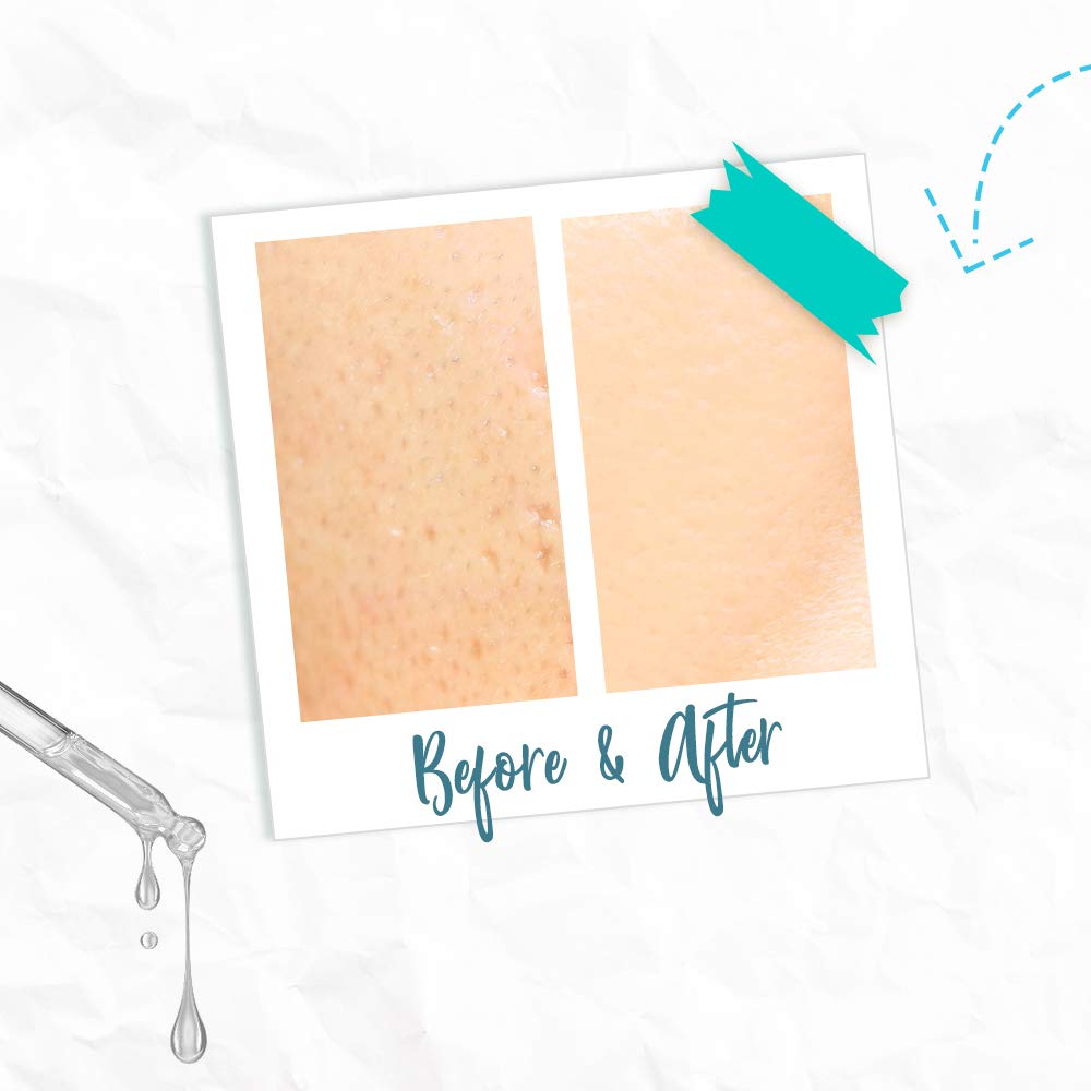 Foto 5 pulgar | Sérum Bye Bye Blemish Skin Rescue Con Niacinamida, 30 Ml - Venta Internacional.