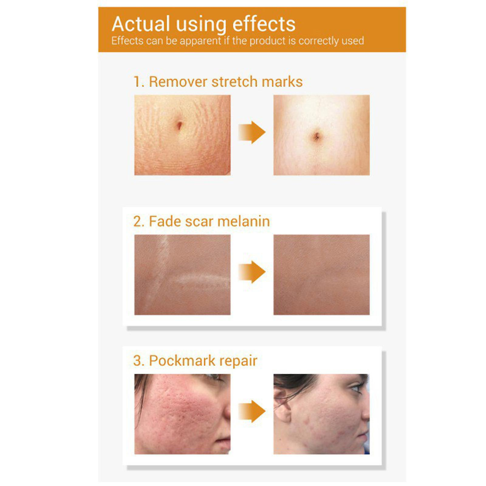 Foto 4 pulgar | Serum Lanbena Para Eliminar Cicatrices De Acné Y Estrías  20 Ml - Venta Internacional.