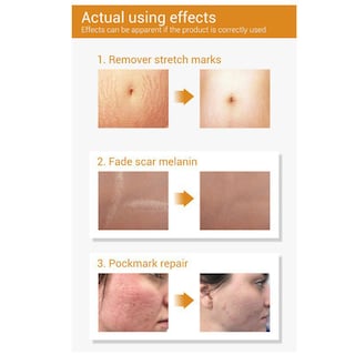 Foto 3 | Serum Lanbena Para Eliminar Cicatrices De Acné Y Estrías 20 Ml - Venta Internacional.