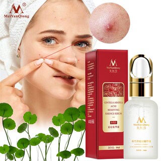 Foto 2 | Sérum Facial Huoguo Tratamiento Para El Acné Centella Asiatica 10 Ml - Venta Internacional.