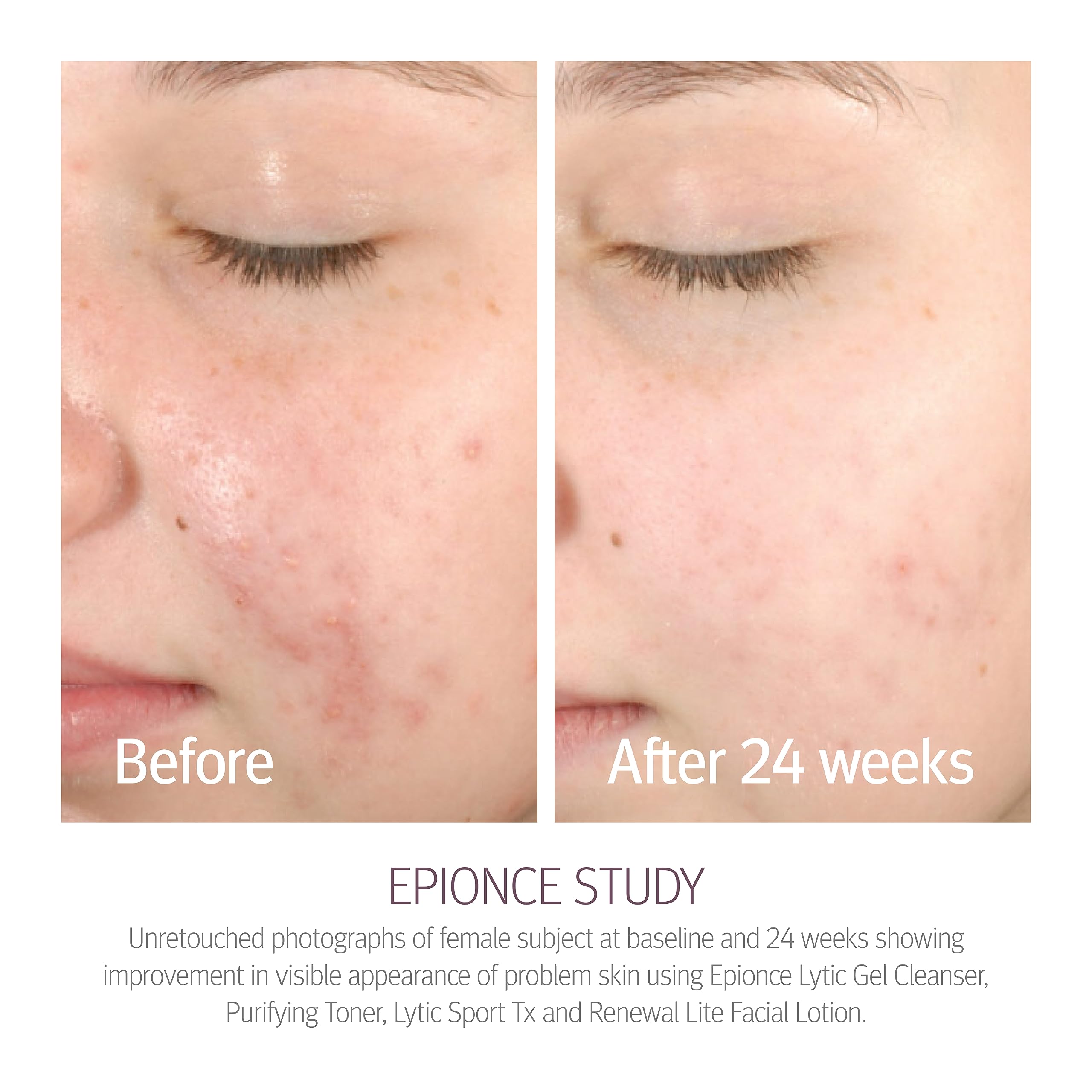 Foto 7 pulgar | Limpiador Facial Purificante Y Desmaquillante Toner Epionce - Venta Internacional.