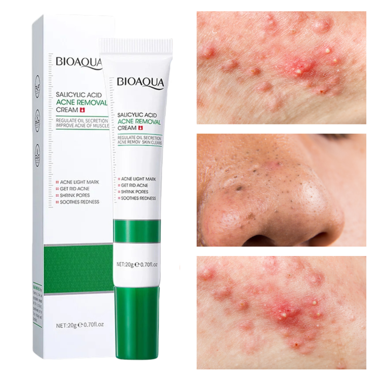 Foto 2 pulgar | Crema Limpieza Facial Ácido Salicílico Anti Acné Cicatriz