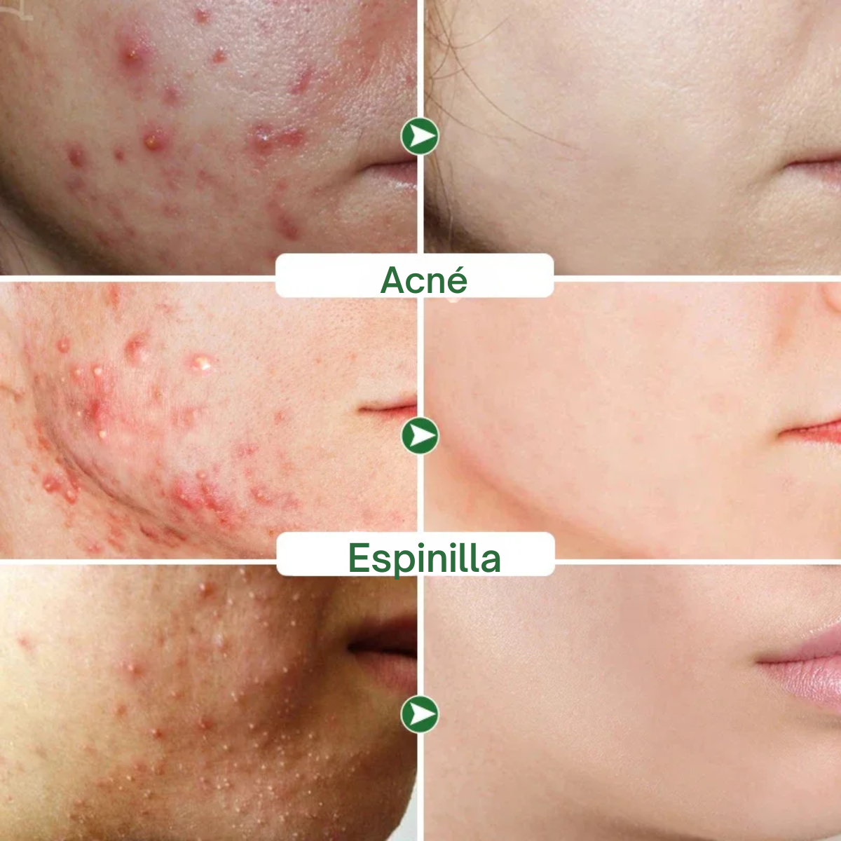 Foto 3 pulgar | Crema Limpieza Facial Ácido Salicílico Anti Acné Cicatriz