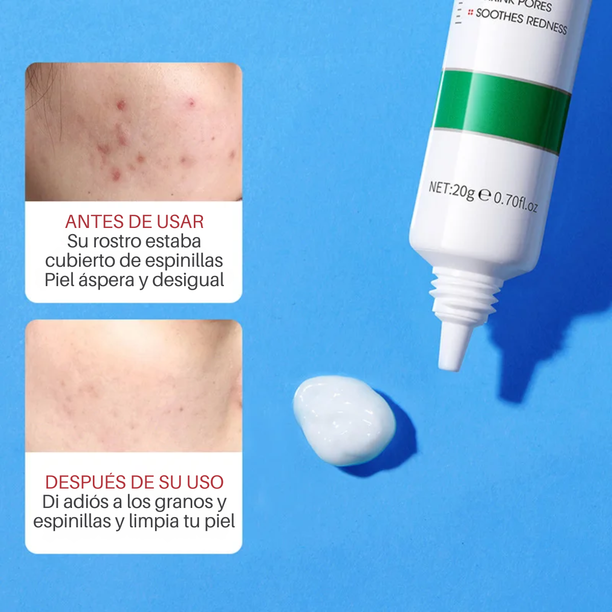 Foto 5 pulgar | Crema Limpieza Facial Ácido Salicílico Anti Acné Cicatriz