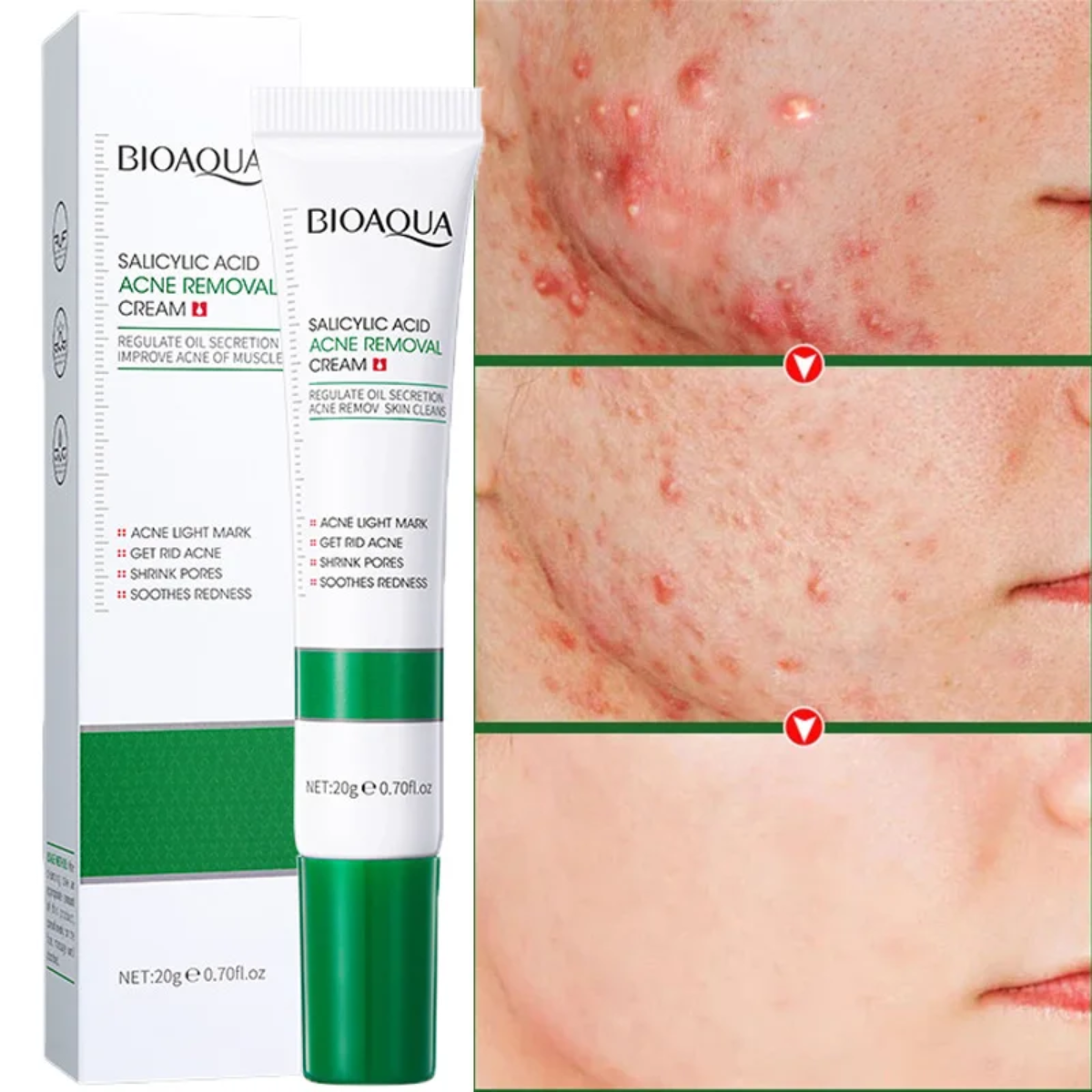 Foto 7 pulgar | Crema Limpieza Facial Ácido Salicílico Anti Acné Cicatriz