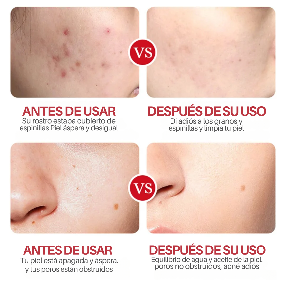 Foto 8 pulgar | Crema Limpieza Facial Ácido Salicílico Anti Acné Cicatriz