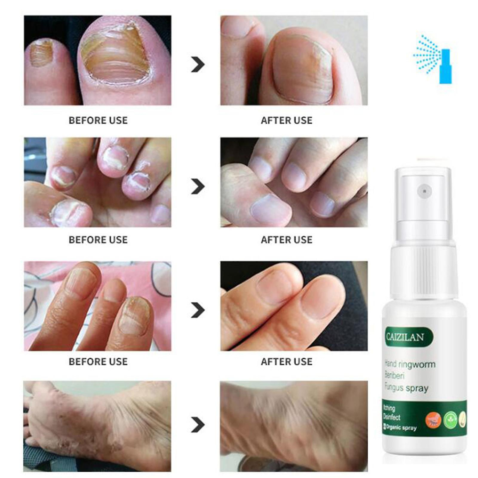 Foto 5 pulgar | Spray Caizilan Para Manos Y Pies  20 Ml - Venta Internacional.