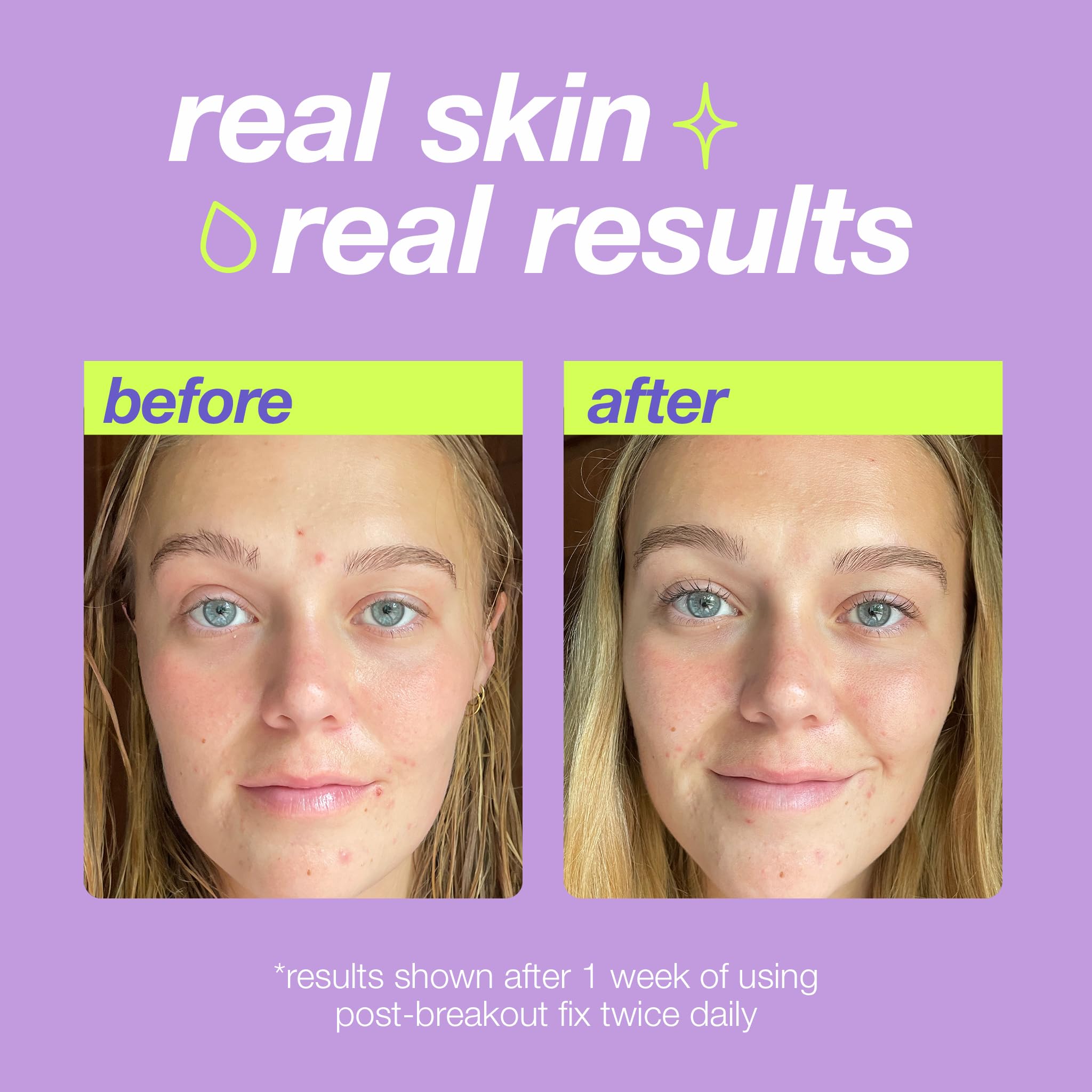 Foto 2 | Tratamiento Localizado Dermalogica Clear Start Post-brote Fix - Venta Internacional.