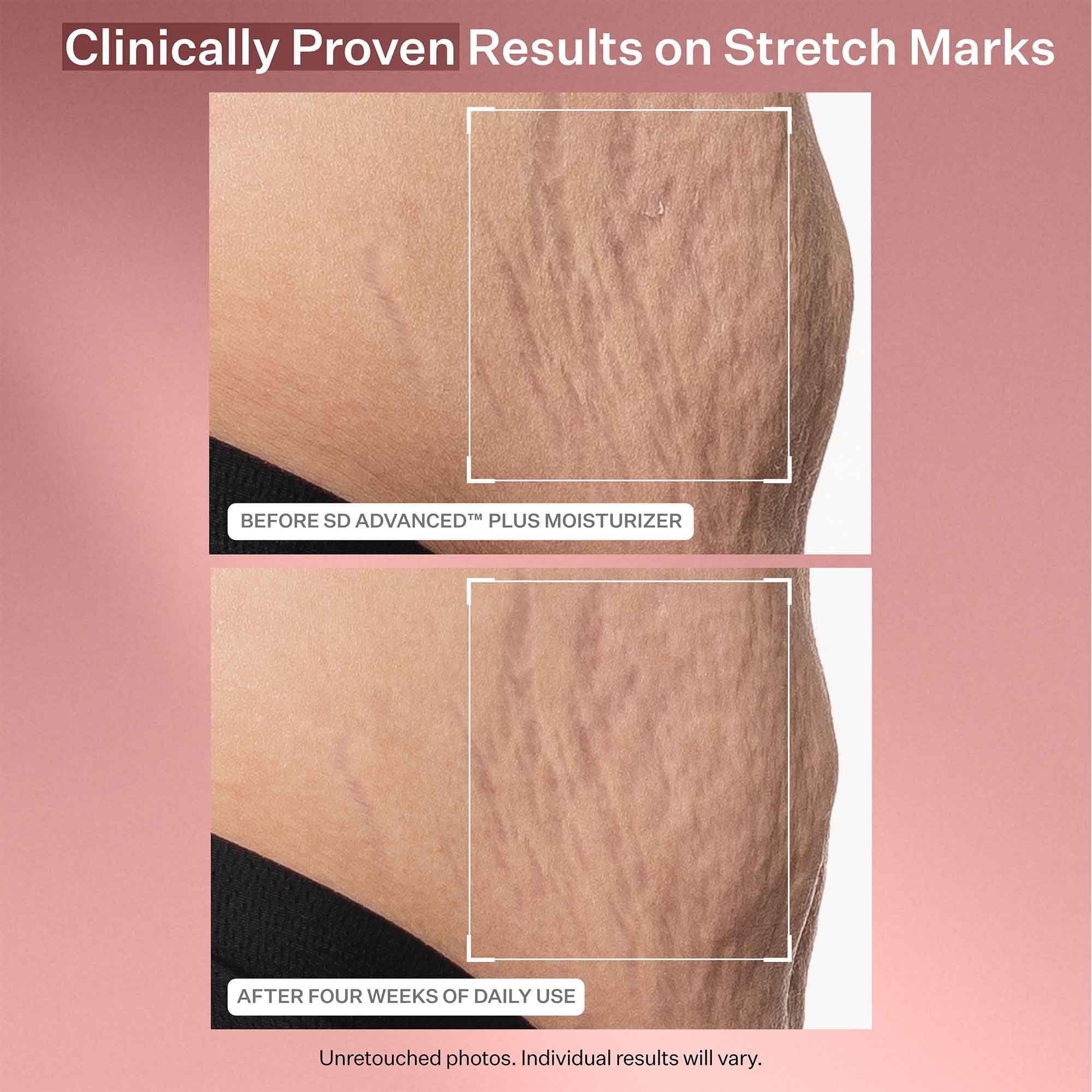 Foto 5 pulgar | Crema Hidratante Strivectin Sd Advanced Plus para Arrugas 60 Ml - Venta Internacional