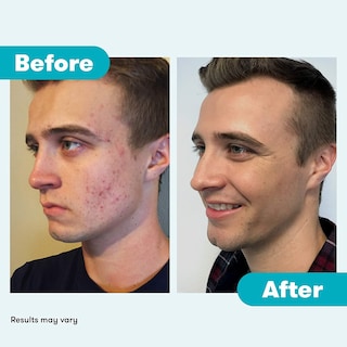 Foto 8 | Tratamiento Para El Acné Proactiv Repair Con Peróxido De Benzoilo Durante 90 Días - Venta Internacional.