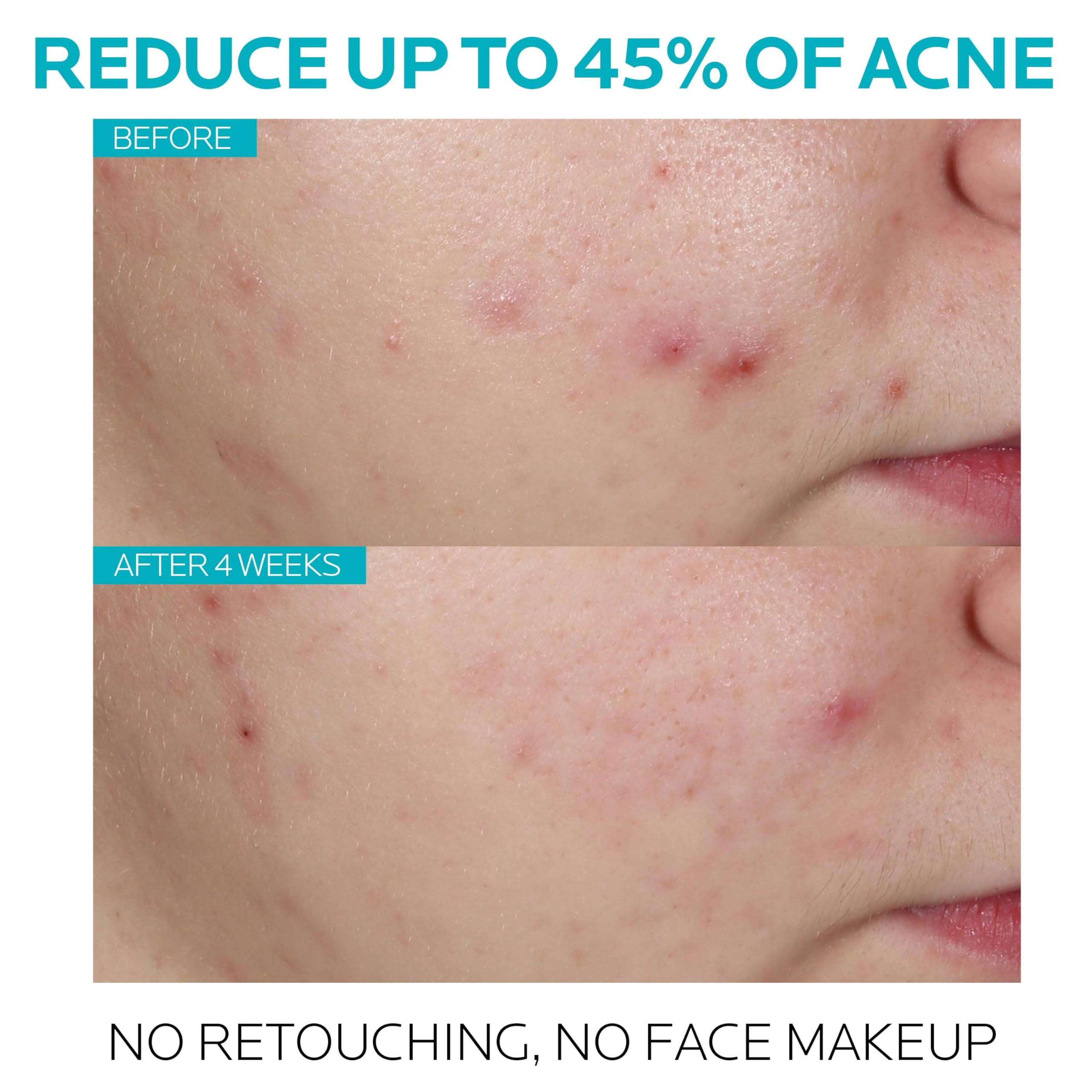 Foto 3 pulgar | Sérum Para El Tratamiento Del Acné La Roche-posay Con Ácido Salicílico Effaclar - Venta Internacional.