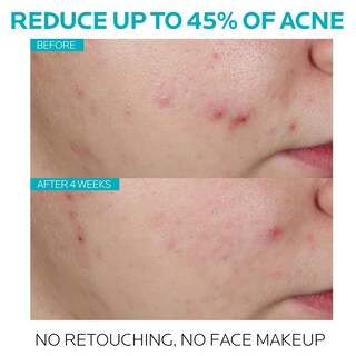 Foto 2 | Sérum Para El Tratamiento Del Acné La Roche-posay Con Ácido Salicílico Effaclar - Venta Internacional.