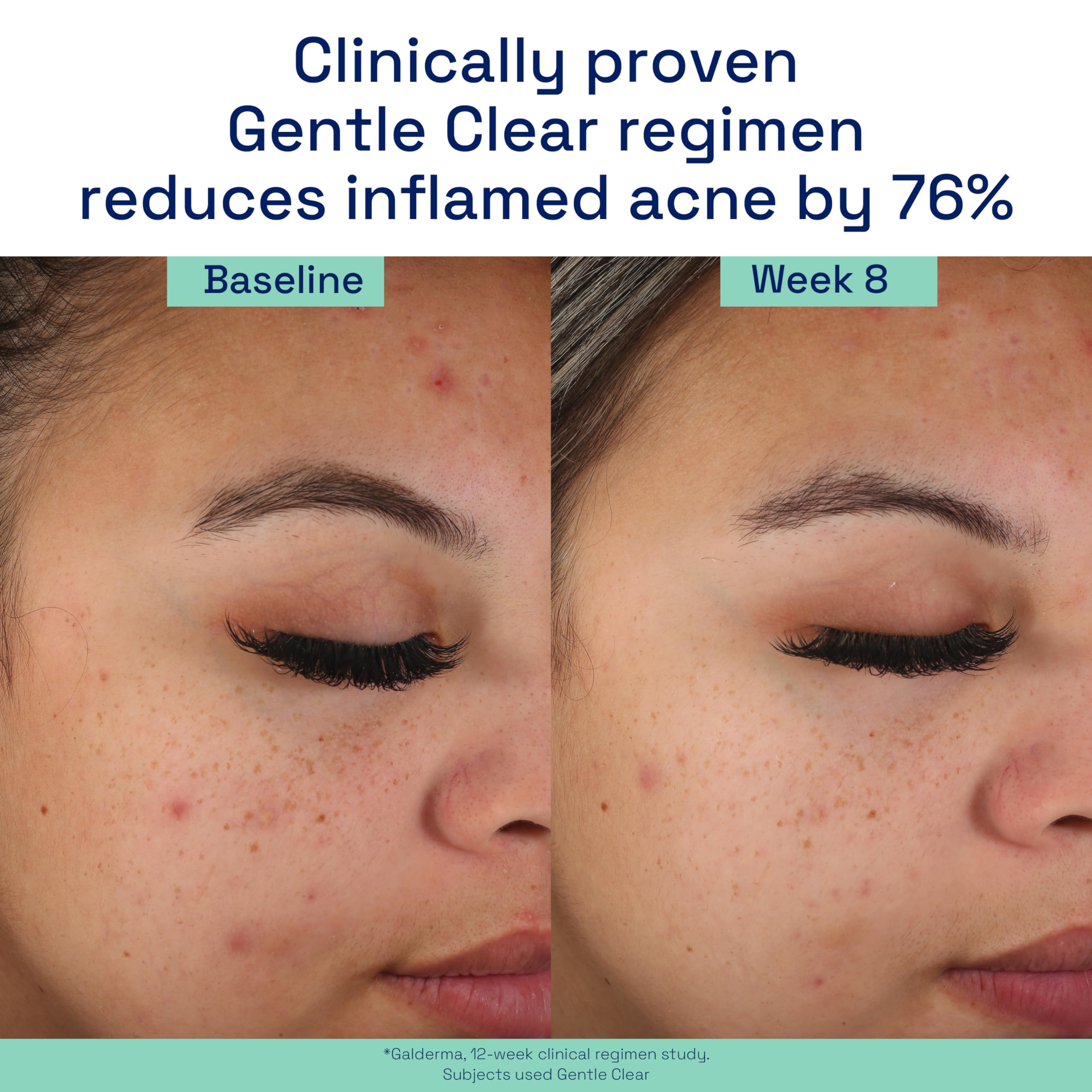 Foto 7 | Crema Hidratante Cetaphil Gentle Clear Matificante Acné 90 Ml - Venta Internacional.