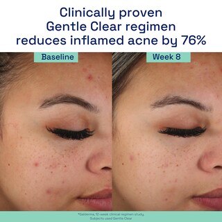 Foto 7 | Crema Hidratante Cetaphil Gentle Clear Matificante Acné 90 Ml - Venta Internacional.