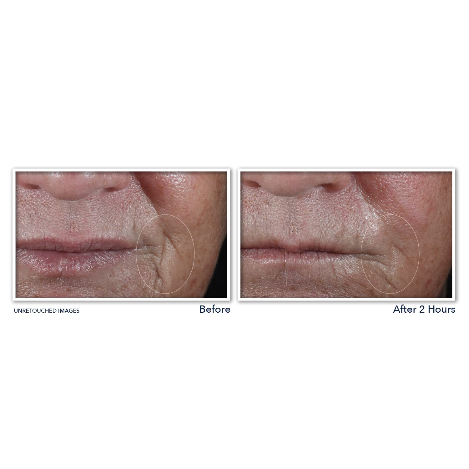 Foto 7 pulgar | Parches Antiarrugas RoC Deep Wrinkle 6 Piezas - Venta Internacional
