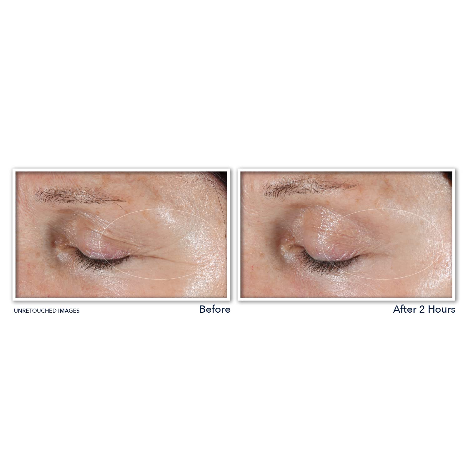 Foto 8 pulgar | Parches Antiarrugas RoC Deep Wrinkle 6 Piezas - Venta Internacional