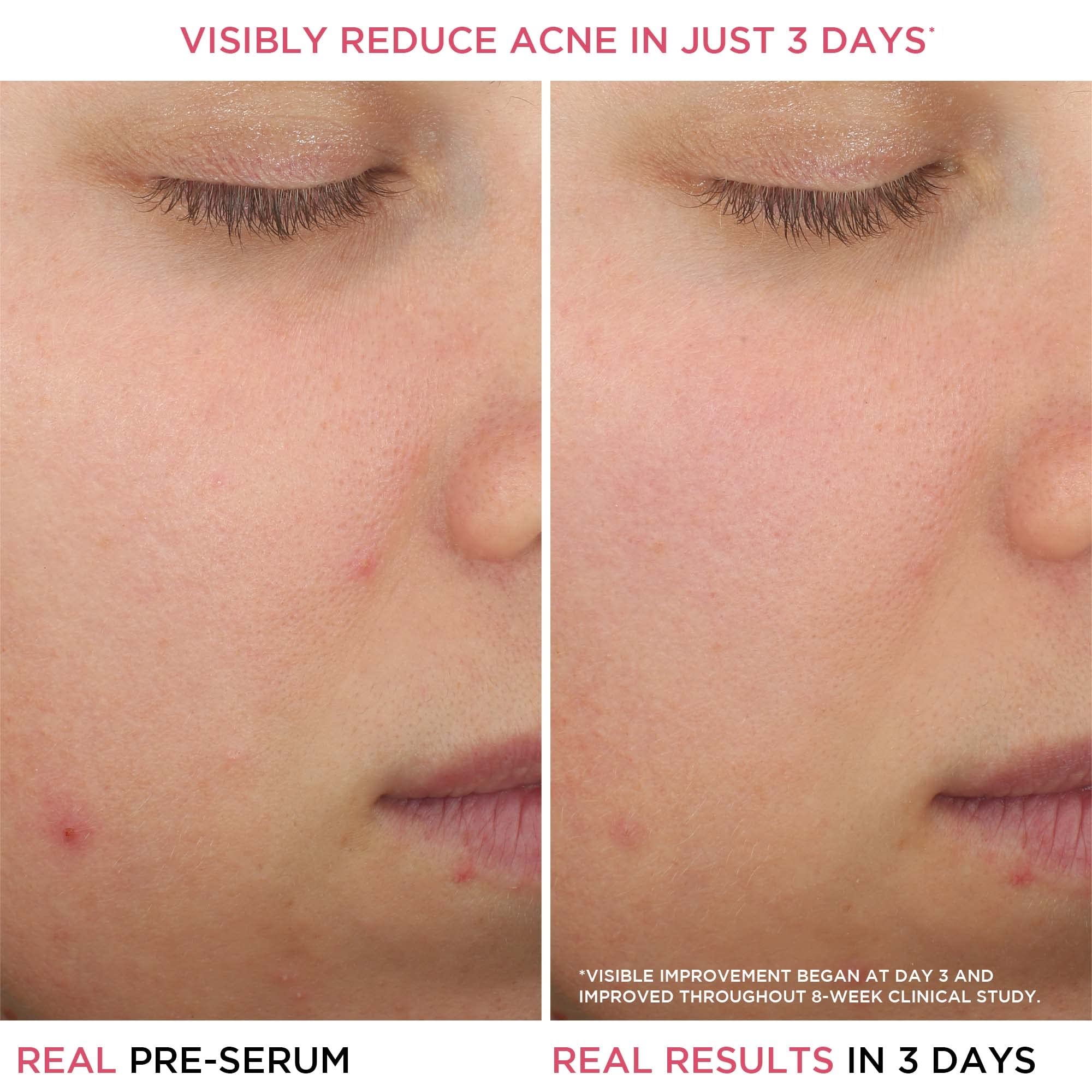 Foto 5 pulgar | Sérum Para El Tratamiento Del Acné It Cosmetics Bye Bye Breakout 30 Ml - Venta Internacional.
