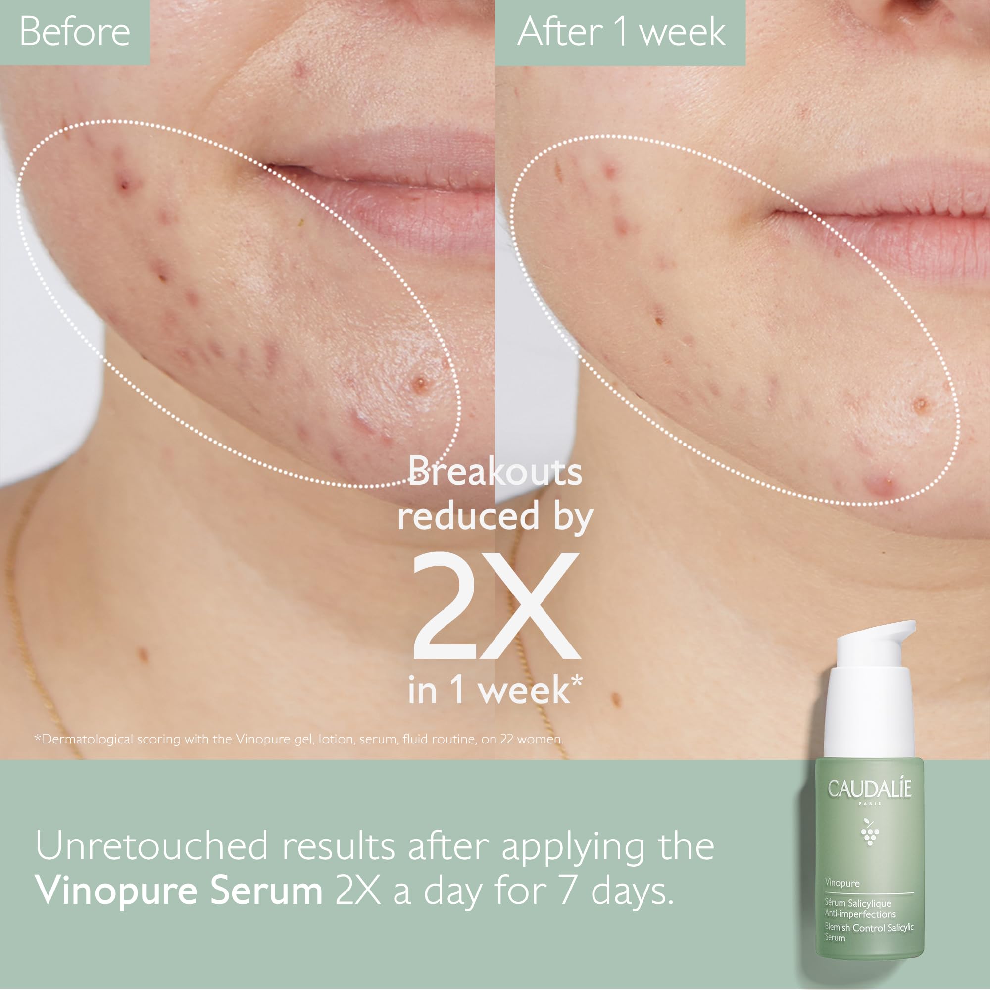 Foto 4 pulgar | Set Para El Cuidado De La Piel Caudalie Vinopure Acne-prone Con Sérum 30 Ml - Venta Internacional.