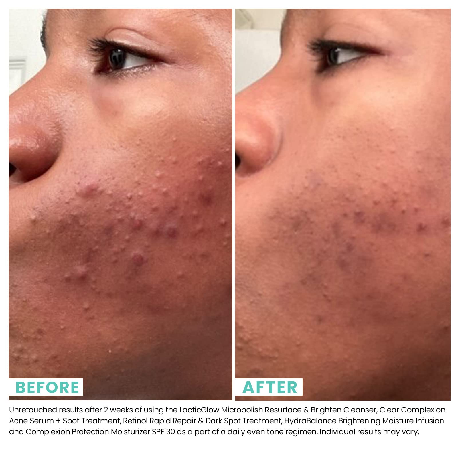 Foto 6 pulgar | Serum + Spot Treatment Urban Skin Rx Clear Complexion - Venta Internacional.