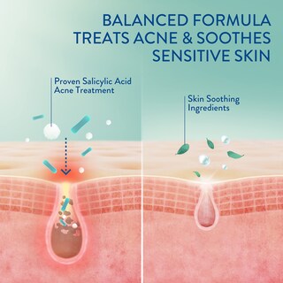 Foto 3 | Sérum Cetaphil Gentle Clear de Triple Acción para el Acné 30 ml con Ácido Salicílico - Venta Internacional