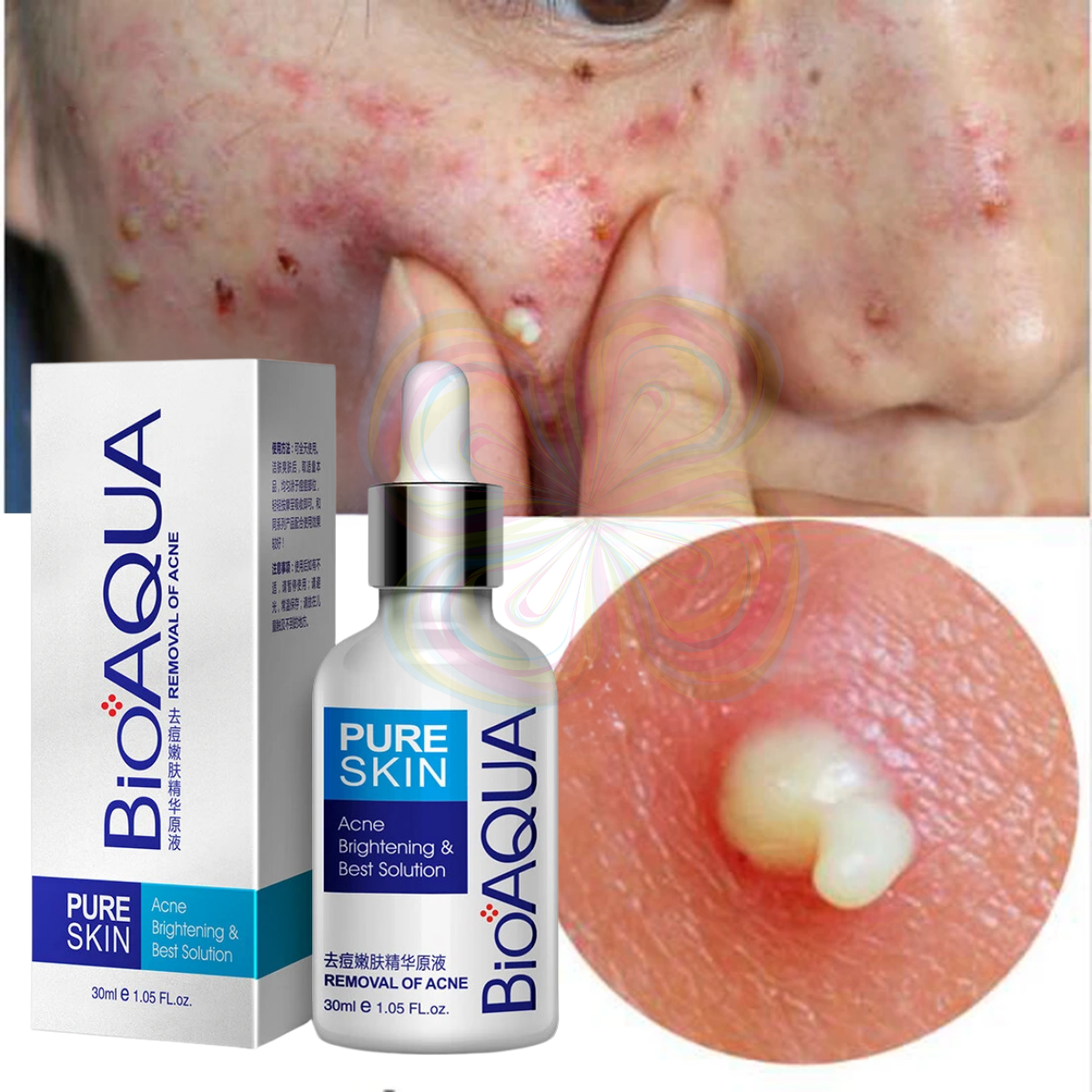 Foto 3 pulgar | Serum Pure Skin Retira Acne Y Espinillas Regenera