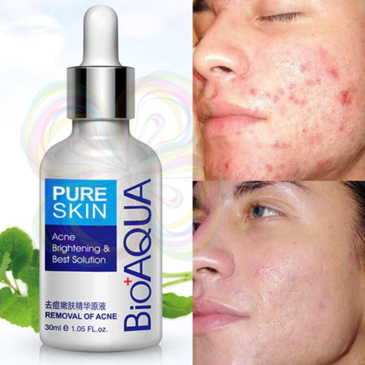 Foto 8 pulgar | Serum Pure Skin Retira Acne Y Espinillas Regenera