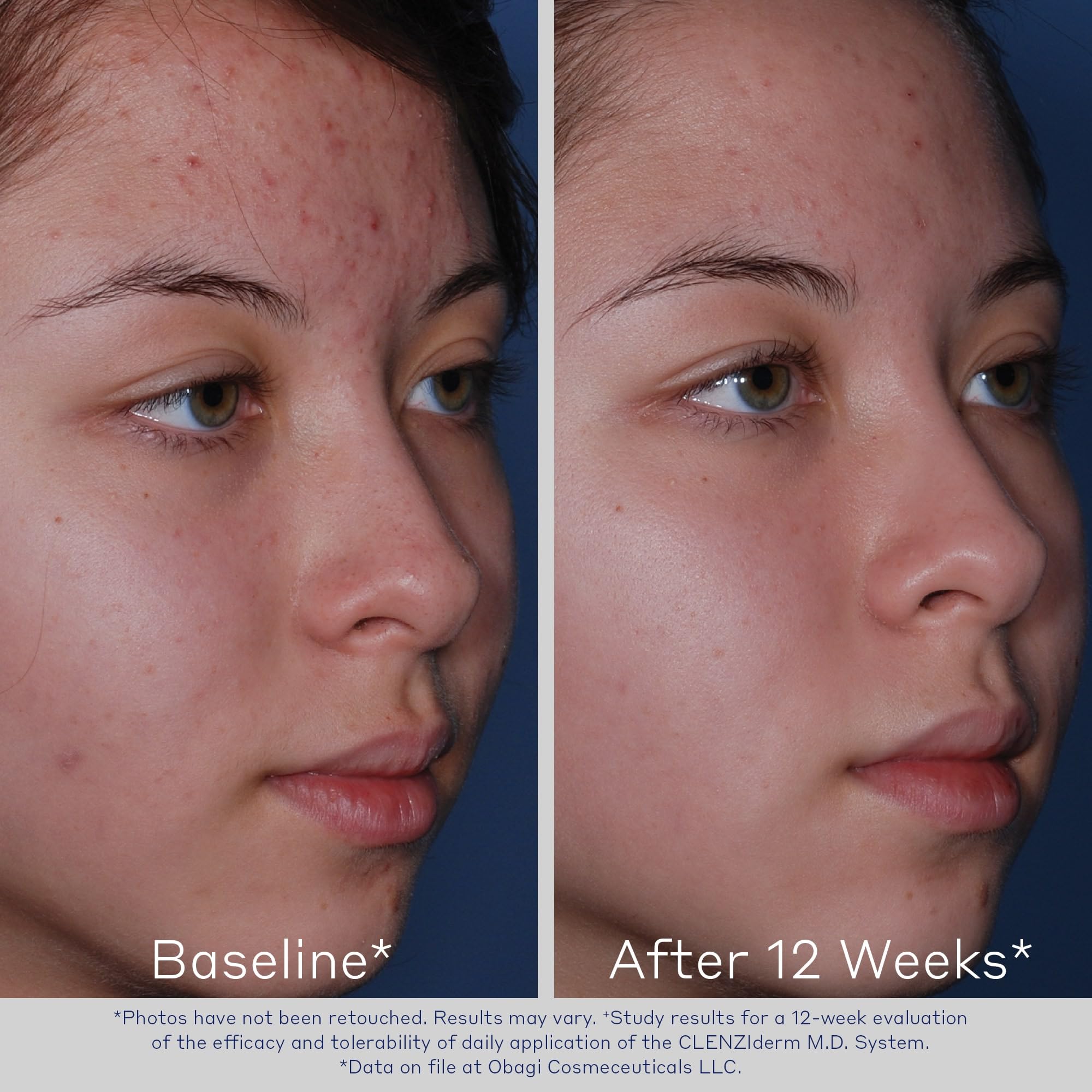 Foto 5 | Tónico Obagi Clenziderm M.d. Pore Therapy 150 Ml Con 2% De Ácido Salicílico - Venta Internacional.