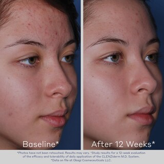 Foto 5 | Tónico Obagi Clenziderm M.d. Pore Therapy 150 Ml Con 2% De Ácido Salicílico - Venta Internacional.