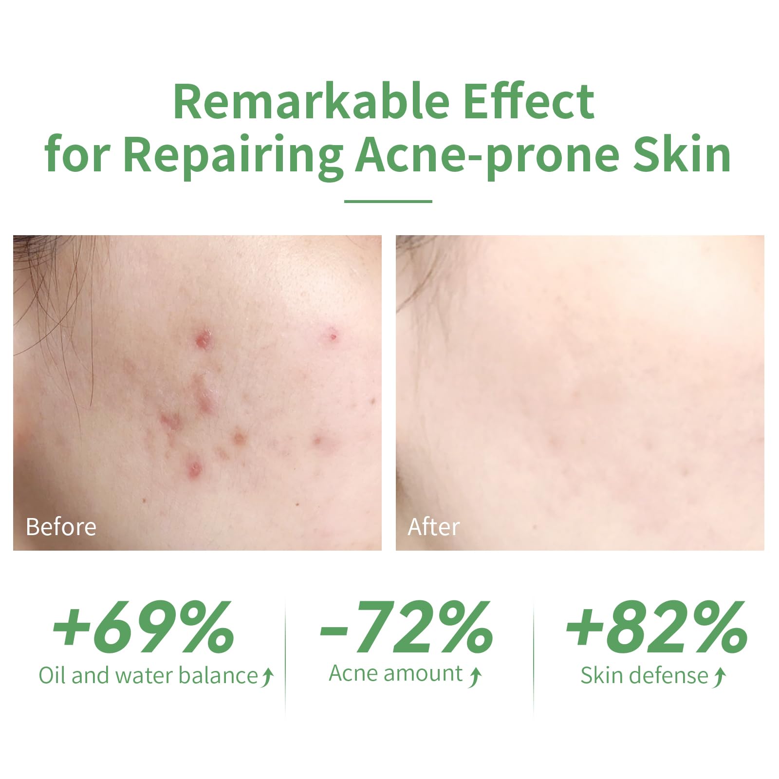 Foto 6 pulgar | Serum Lanbena Para Tratamiento Del Acné Con 10% De Ácido Salicílico, 15 Ml - Venta Internacional.