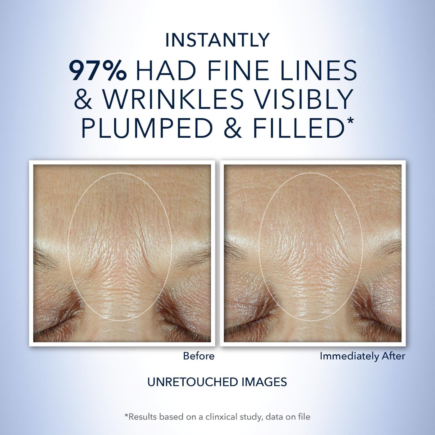 Foto 5 pulgar | Sérum Roc Derm Correxion Fill + Treat Advanced Retinol, 15 Ml - Venta Internacional.