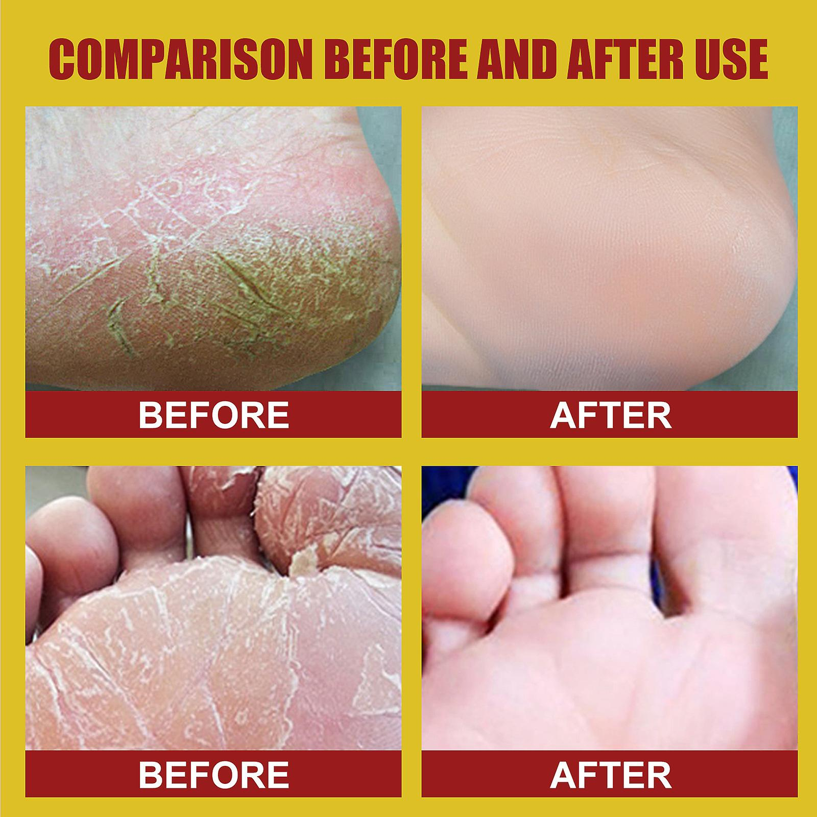 Foto 6 pulgar | Mascarilla Exfoliante Para Piel Muerta  Pies Secos Y Agrietados - Venta Internacional.