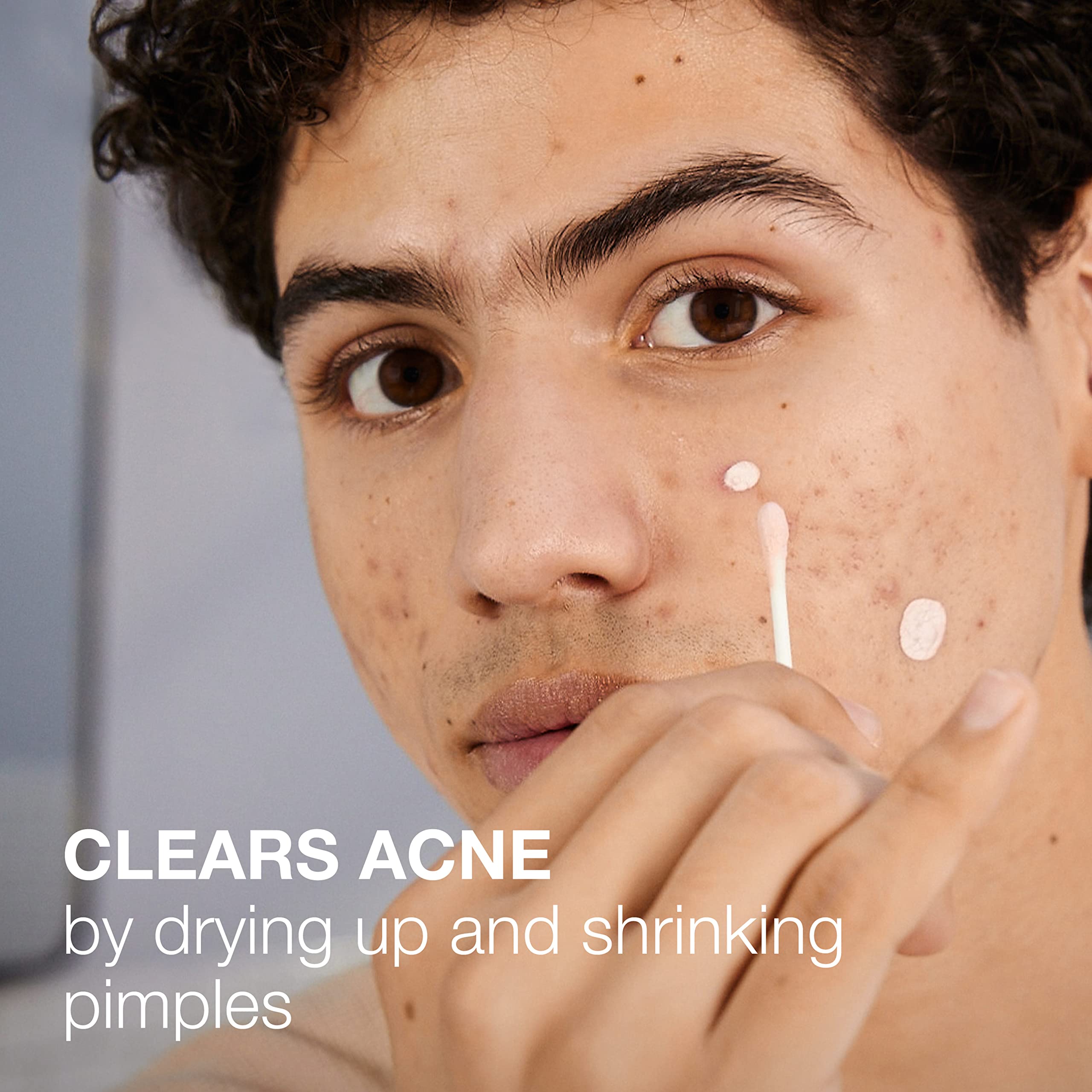 Foto 4 pulgar | Loción Secante Para Manchas De Acné Neutrogena Stubborn, 30 Ml, 10% Azufre - Venta Internacional.