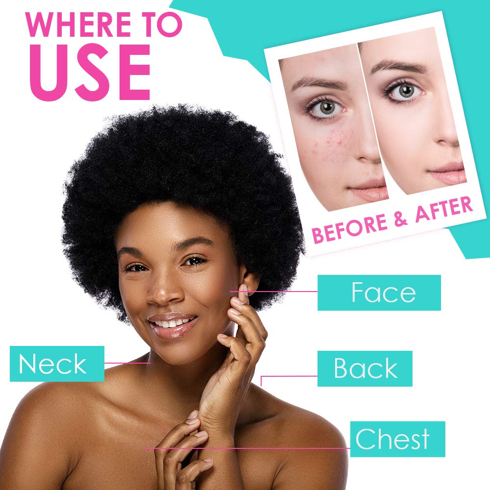 Foto 6 pulgar | Loción Secante Para El Acné Bye Bye Bye Blemish Reduce Las Espinillas, 30 Ml, Paquete De 3 - Venta Internacional.