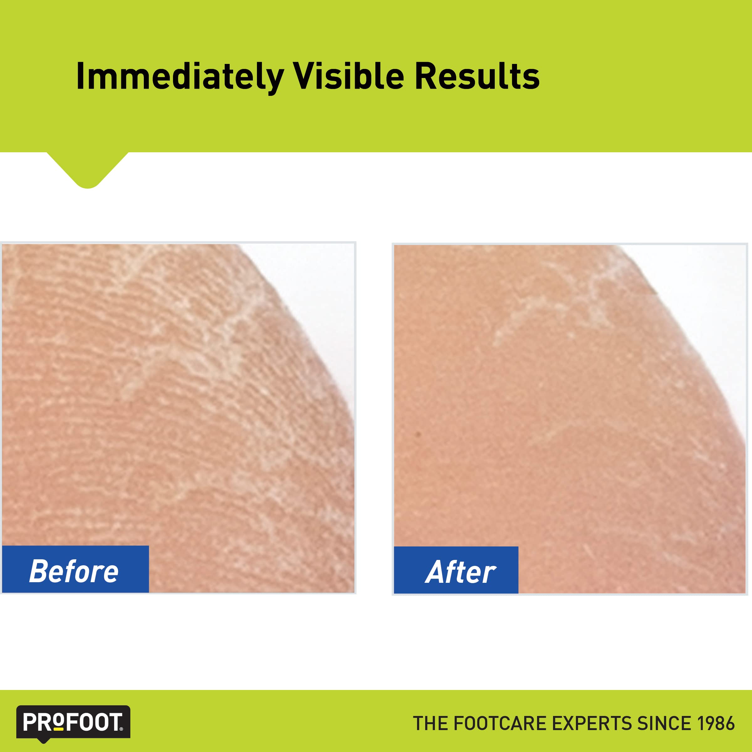 Foto 5 pulgar | Crema Para Pies Profoot Heel Rescue, 473 Ml, Paquete De 2 Unidades Para Piel Agrietada - Venta Internacional.