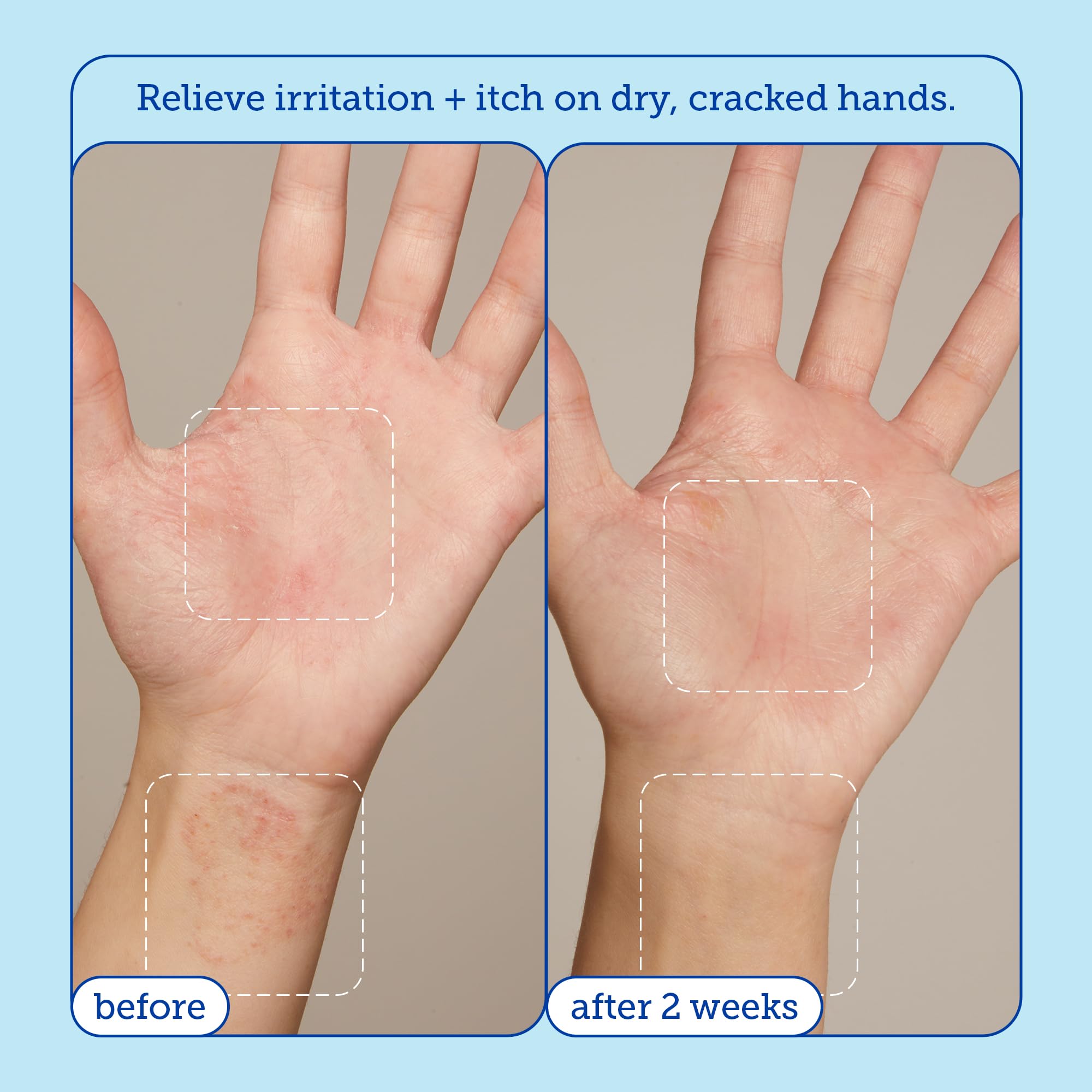 Foto 5 pulgar | Crema Para Aliviar Las Manos Skinfix Reduce El Enrojecimiento  90 Ml  Piel Seca - Venta Internacional.