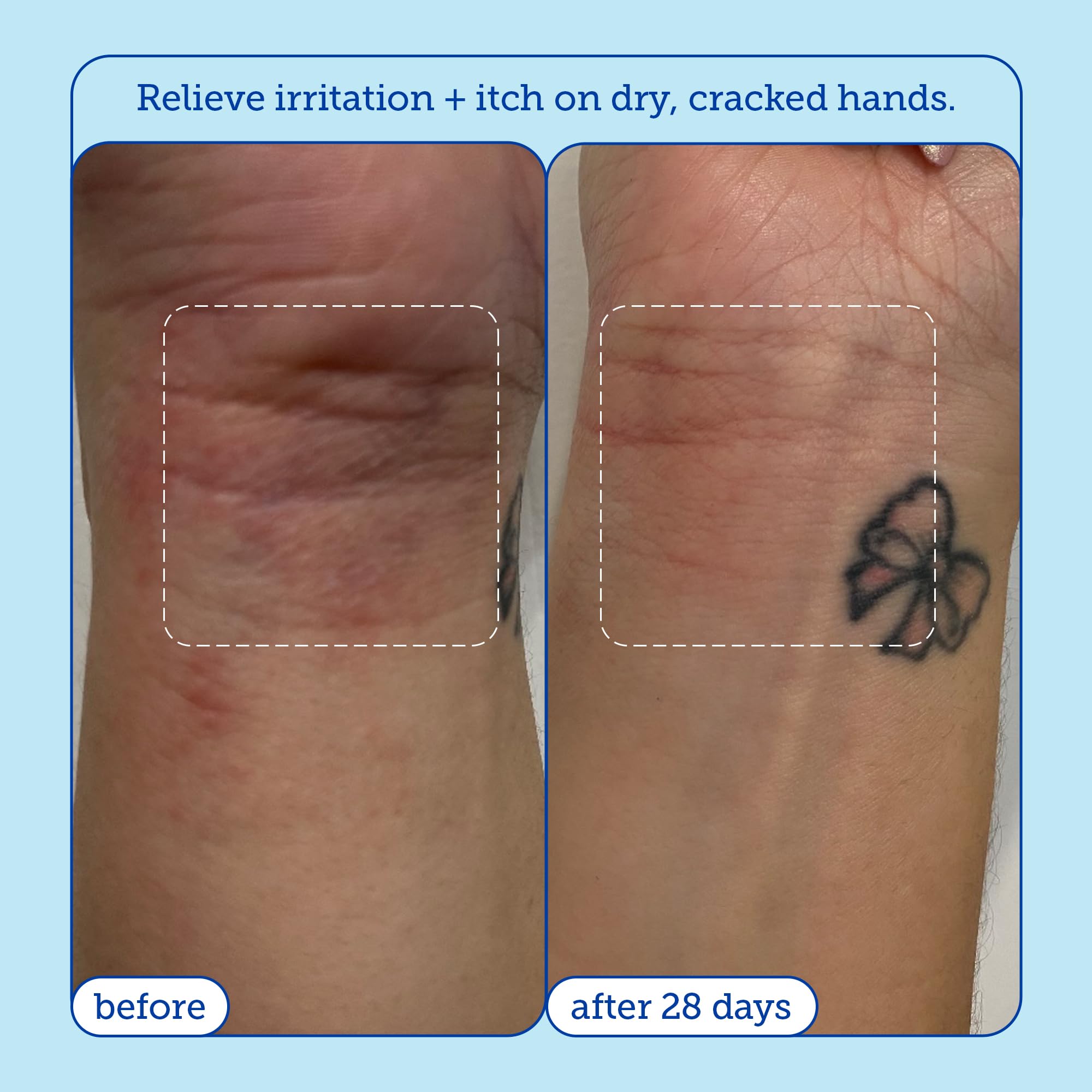 Foto 6 pulgar | Crema Para Aliviar Las Manos Skinfix Reduce El Enrojecimiento  90 Ml  Piel Seca - Venta Internacional.
