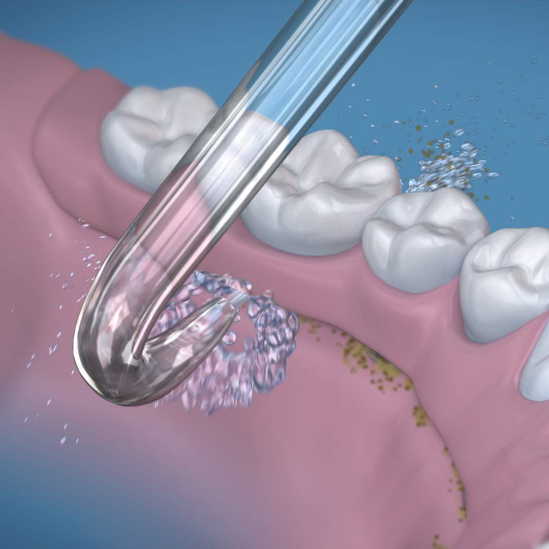 Foto 4 pulgar | Repuesto De Punta De Hilo Dental Waterpik Dt-100e, 2 Unidades - Venta Internacional.